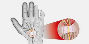 Síndrome do Túnel do Carpo